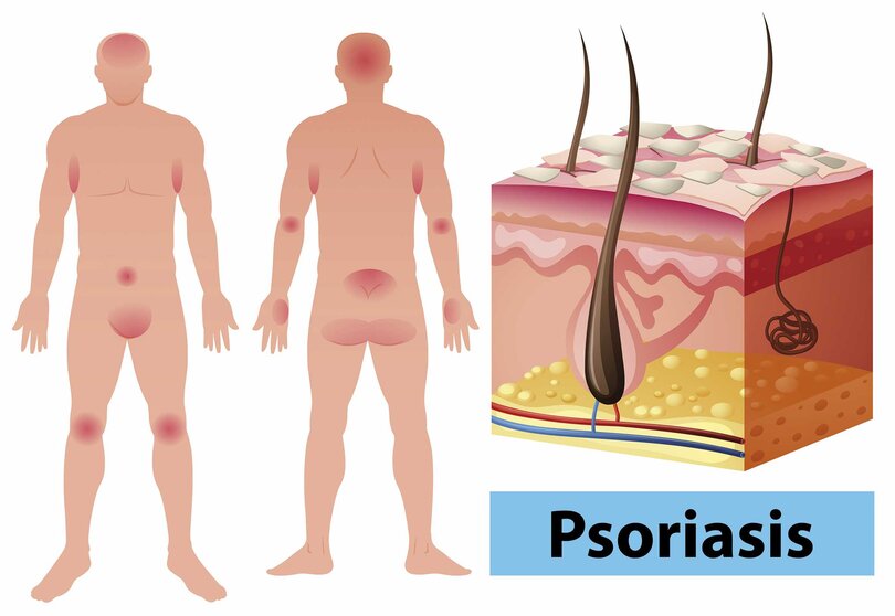 fotopsoriasis 1-2