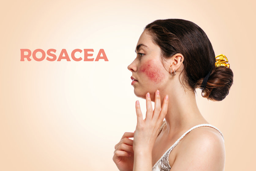 rosacea