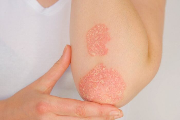 psoriasis